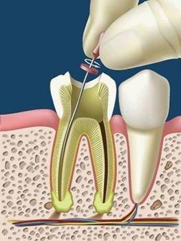 Endodoncias dentales en Valencia