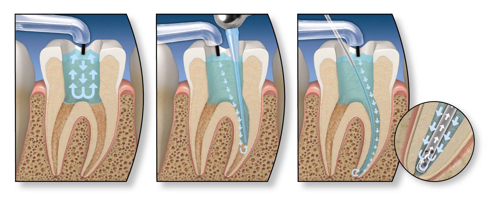 Endodoncias dentales en Valencia