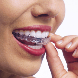 Ortodoncia-Invisible Invisalign Valencia