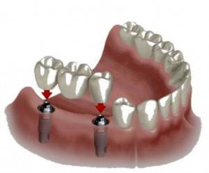 Precio implantes dentales Valencia