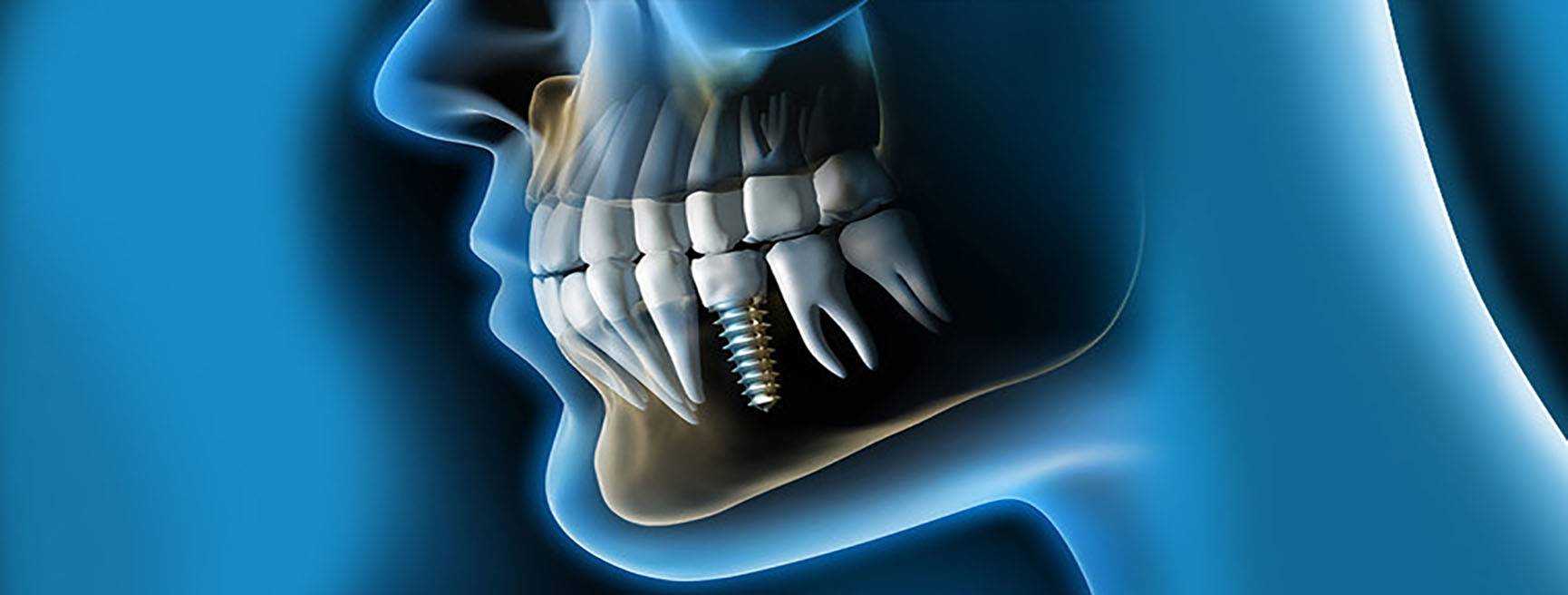 Implantes dentales Valencia