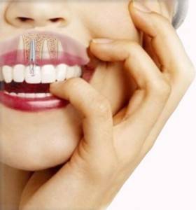 Tratamientos de implantes dentales