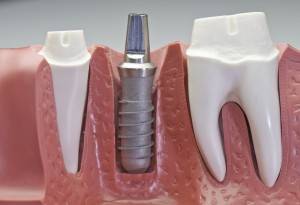 Realizamos implantes dentales en Valencia