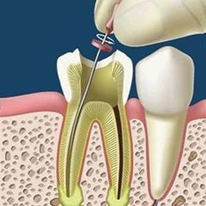 Endodoncias dentales