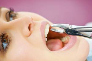 Extracciones dentales