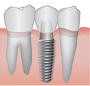 Implantología dental