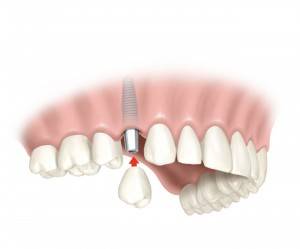 Oferta en implantes dentales