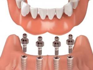 Implantología dental de calidad