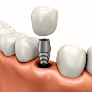 Precio en implantes dentales en Valencia