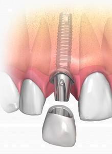 Oferta de implantes en Valencia