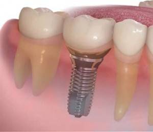 Implantes dentales Valencia