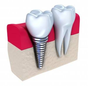 Precio de implantes dentales en Valencia