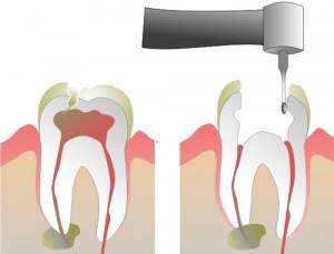 Endodoncias dentales Valencia