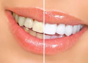 Tratamiento de blanqueamiento dental