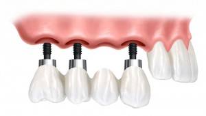 Profesionales en implantes dentales Valencia