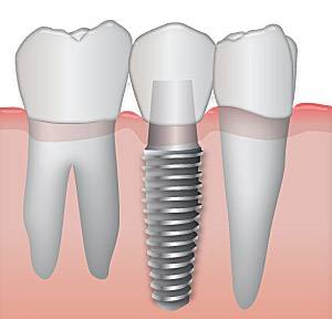 Implantes Valencia al mejor precio