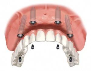 Implantología dental Valencia