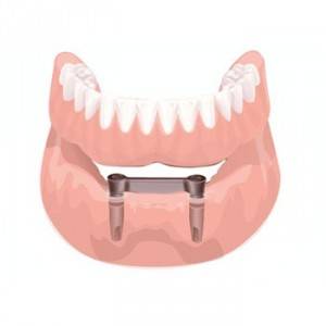 Precio para implantes dentales Valencia