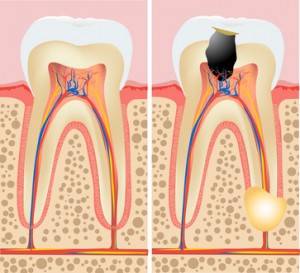 Endodoncias dentales Valencia