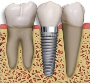 Implantes de última tecnología Valencia