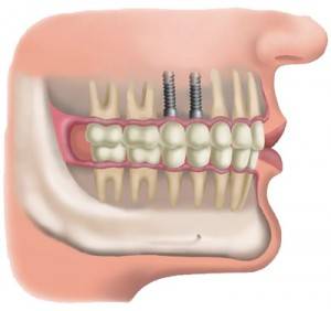 Implantes dentales en Valencia