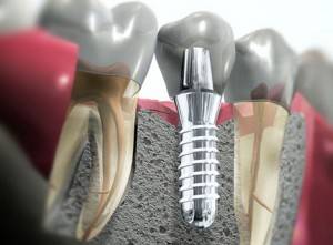 Presupuesto implantes dentales Valencia