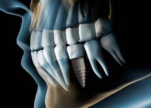 Valoración implantología gratuita Valencia - Radiografía de implantes dentales