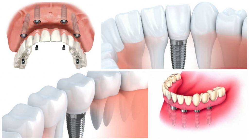 Tratamientos de implantología Valencia - Odontólogos profesionales