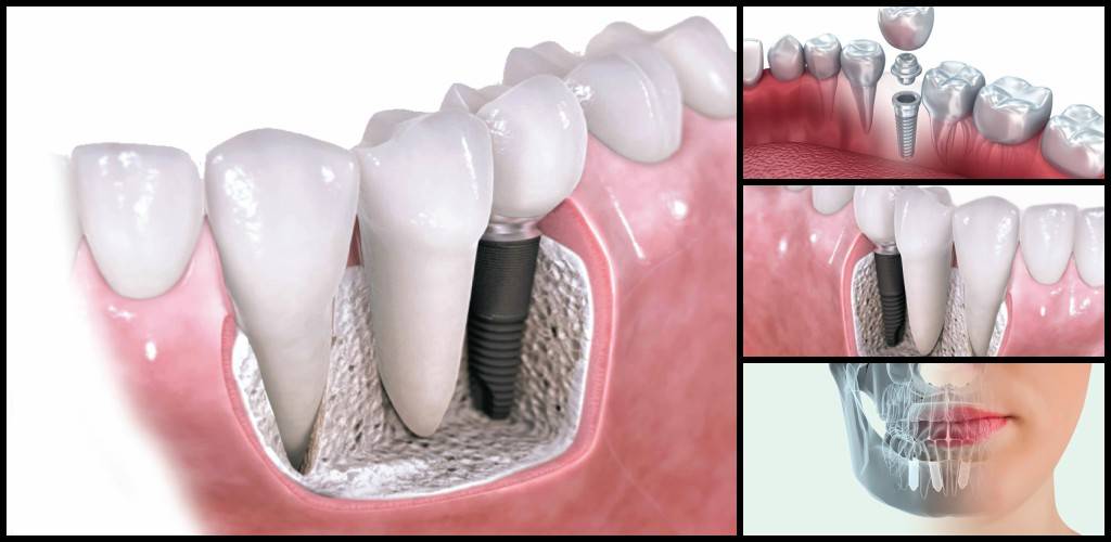 Implantes Valencia - Servicios de implantología dental