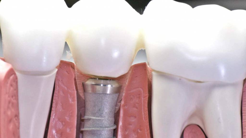 Implantes dentales Valencia - Clínica dental con experiencia