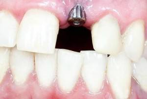 Implantes dentales Valencia - Solución definitva para sustituir dientes