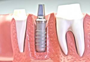 Implantes Valencia profesionales - Clínica dental profesional