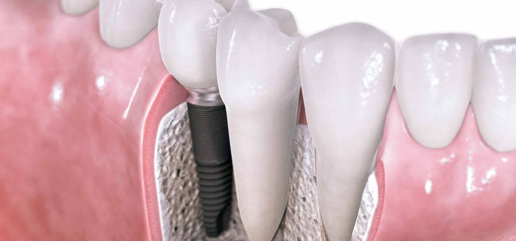 Implantología dental Valencia - Tratamientos de alta calidad