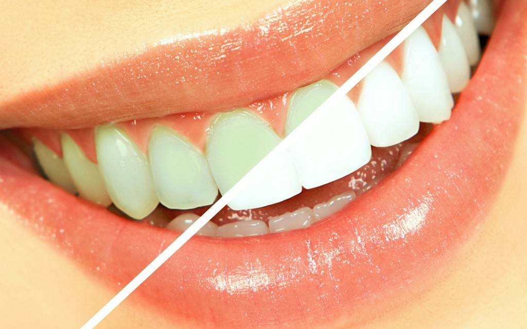 Blanqueamiento dental Valencia - Odontólogos profesionales