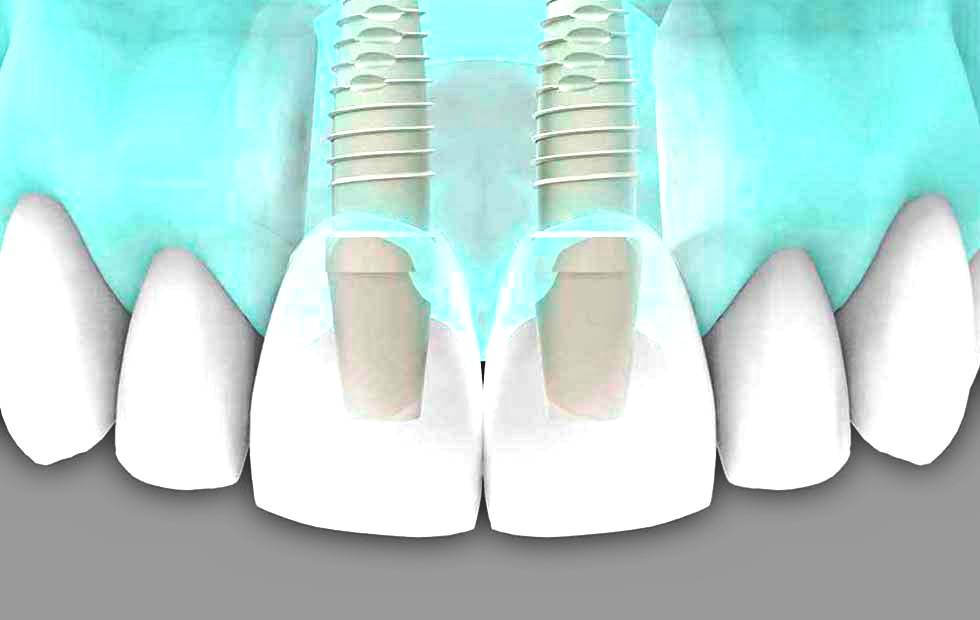 Implantes dentales Valencia - Tratamientos de implantología dental