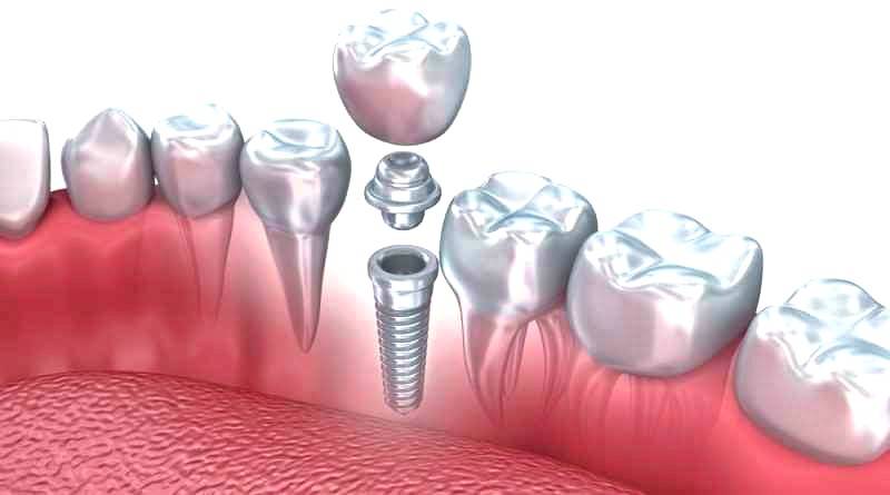 Implantología dental Valencia - Clínica con experiencia