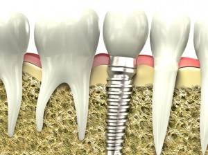 Implantes dentales Valencia - Clínica de implantología dental