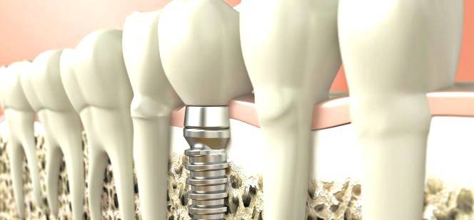 Implantes dentales Valencia - Implantología dental de calidad