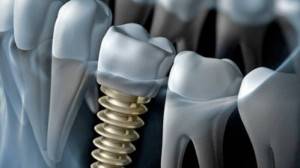Implantes dentales Valencia - Clínica Dental Almar