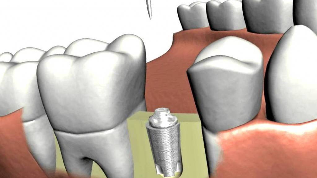 Presupuesto implantes dentales Valencia - Clínica dental en Valencia