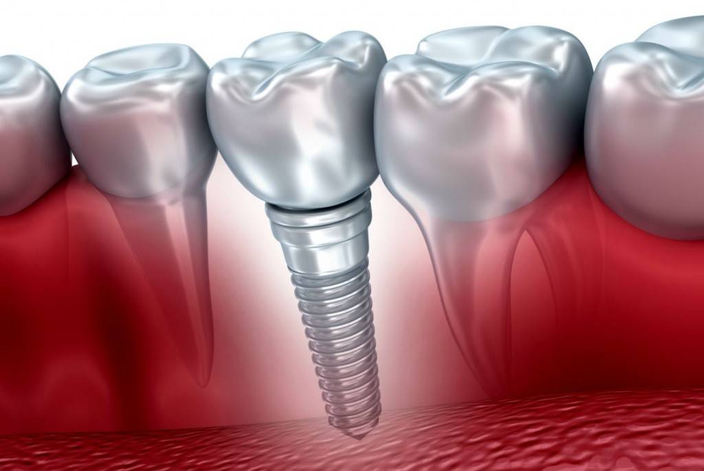 Implantología dental Valencia - Años de experiencia en el sector