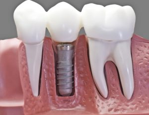 Cirugía de implante dental Valencia