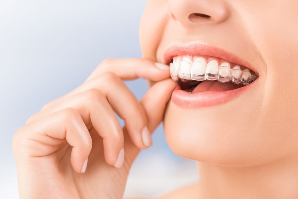 Tecnología invisalign Valencia