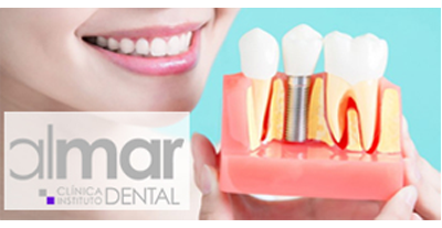 implantes dentales en Valencia - Clinica Almar