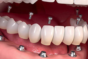 Clínica de implantología dental Valencia