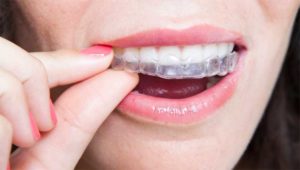 Ortodoncia invisible invisalign Valencia