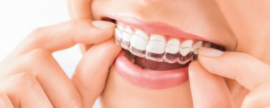 Ortodoncia invisible invisalign Valencia prorfesional