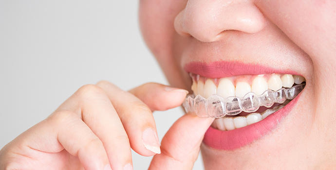 Clínica invisalign provider Valencia