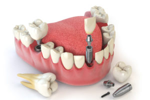 Implantes y dientes en el día Valencia