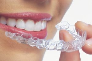 Invisalign provider Valencia